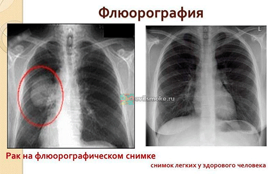 Фото-Рентген легких не курящего и курильщика